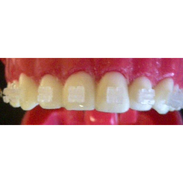 Cx Ceramic .022 MBT Hooks on 3,4,5's (partial set)